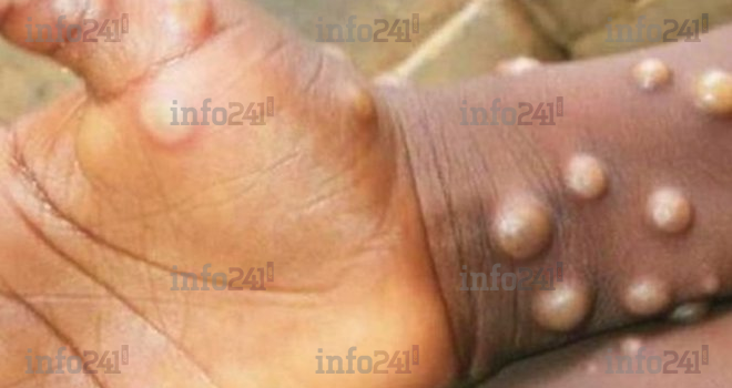 L’OMS annonce la fin de l’état d’urgence dû à la variole du singe