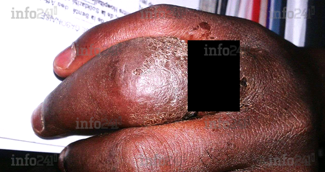 Une bague magique dévore le doigt de son acquéreur à Mbigou